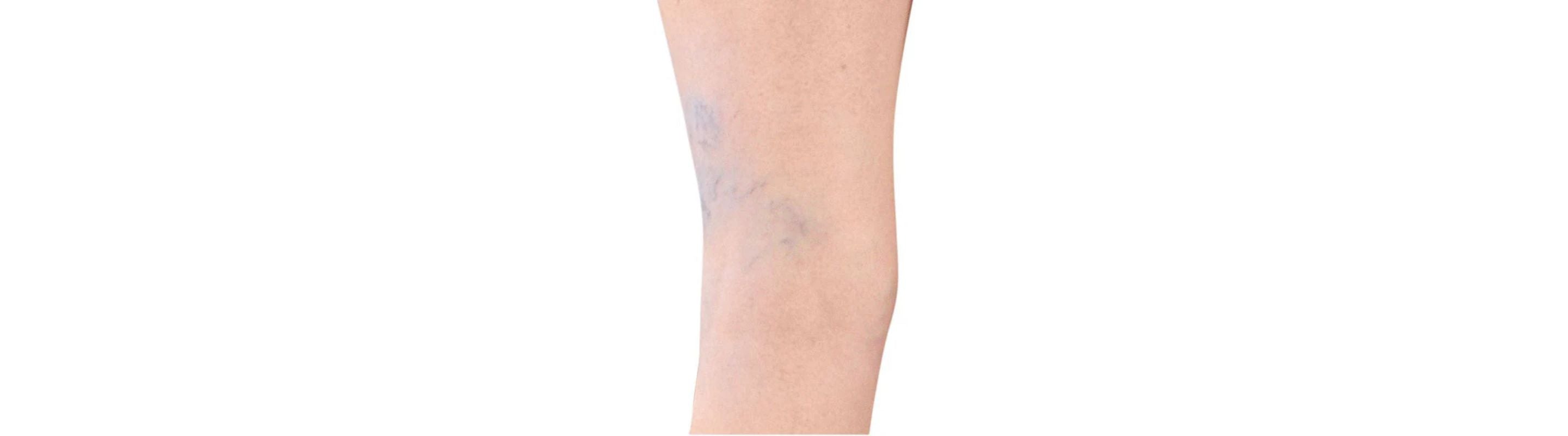 Spider veins on the back of a leg