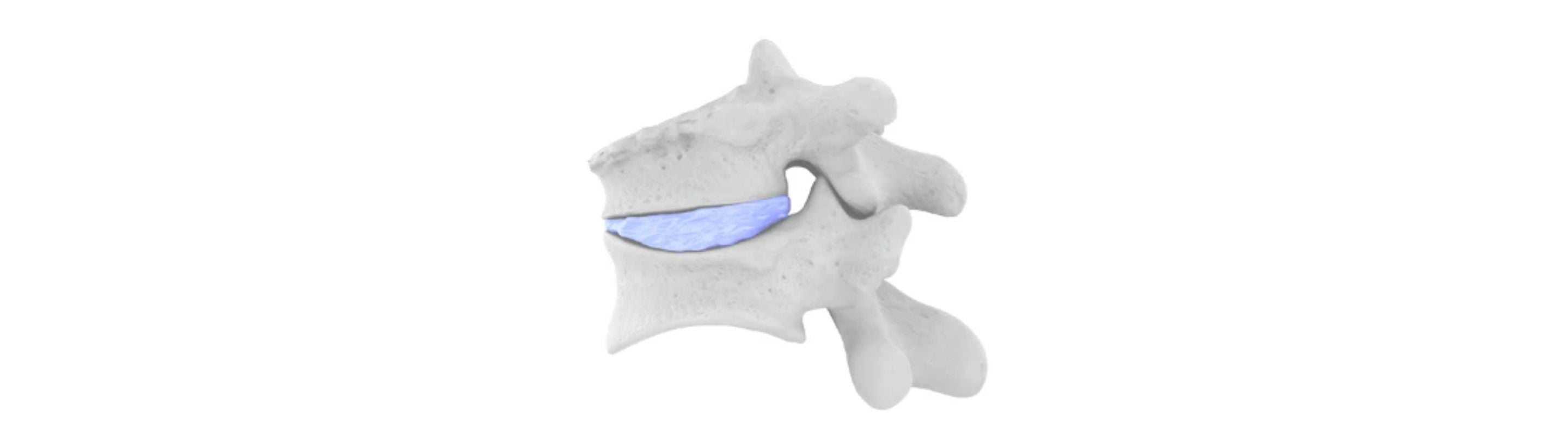 image of two vertebrae with a disk in between them. The top vertebra looks to have a crack, indicating a compression fracture.
