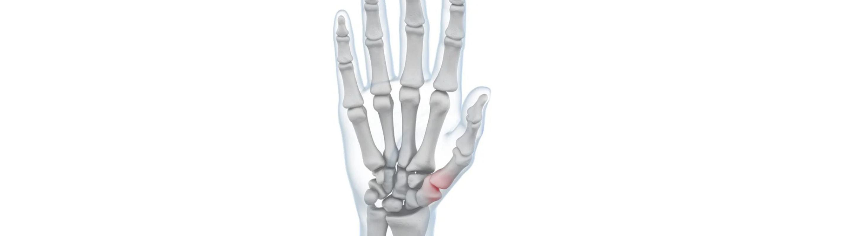 illustration of the hand with see through skin. You can see a red area over the thumb joint, indicating pain.