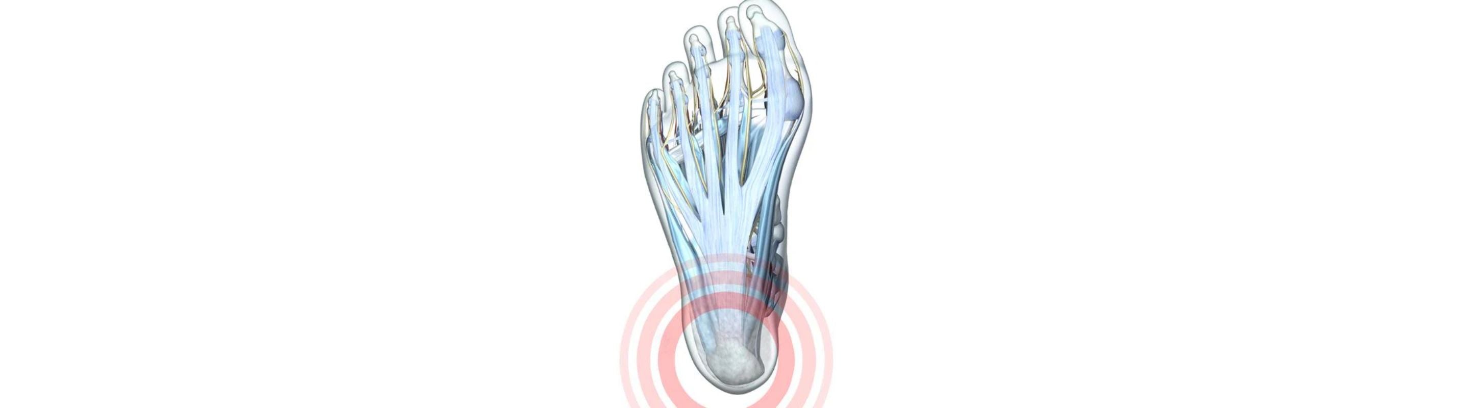 Illustration of the foot with see-through skin. You can see the bones underneath and there is a red circle around the calcaneus, indicating heel pain