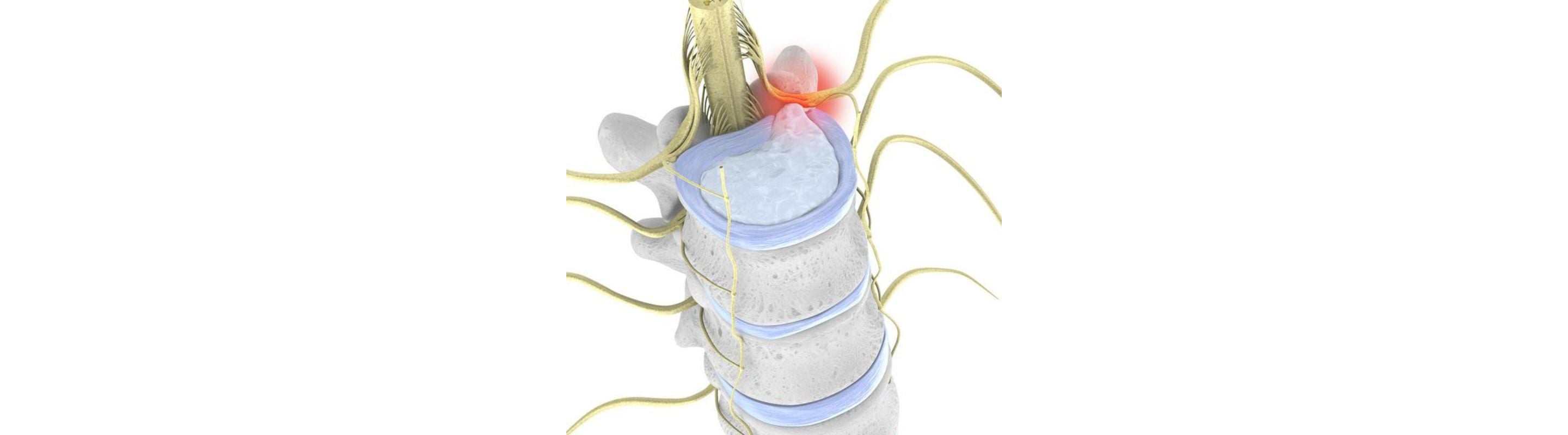 Illustration of the spine. At the top sits a blue disc that is bulging into the spinal column, indicating disc herniation