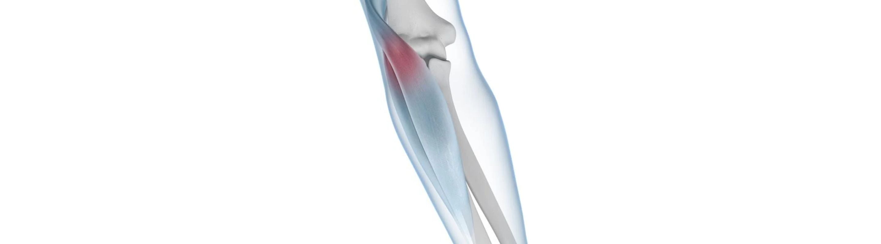 see through illustration of the arm so that the elbow bone and muscles are visible. There is a red zone of irritation around the epicondyle, indicating Tennis Elbow Pain