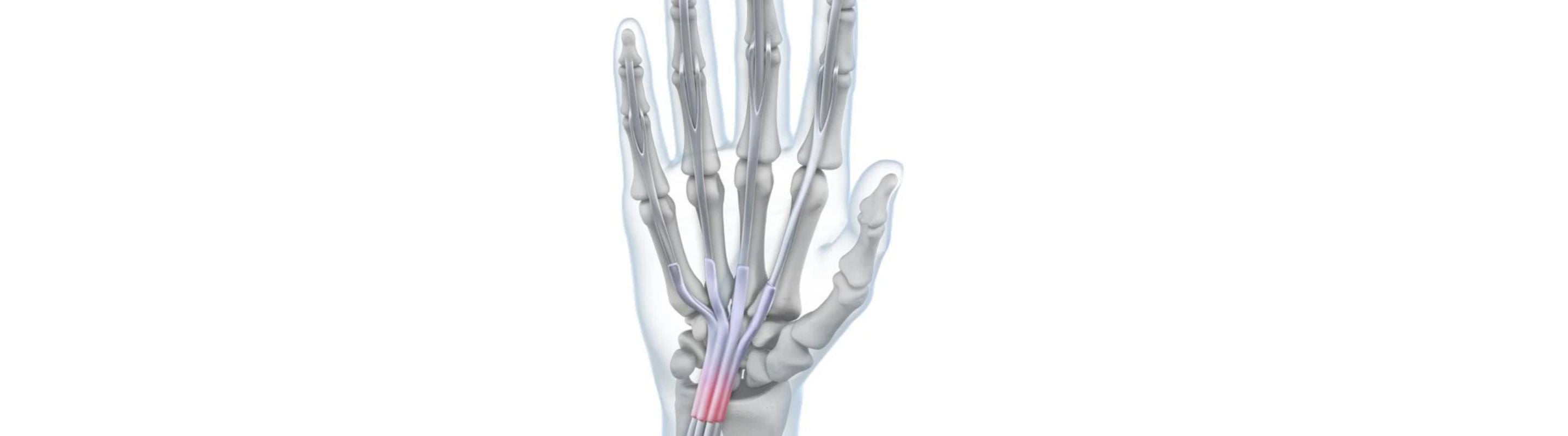 illustration of the hand with see-through skin. There is redness over the wrist tendons, indicating wrist tendonitis pain.