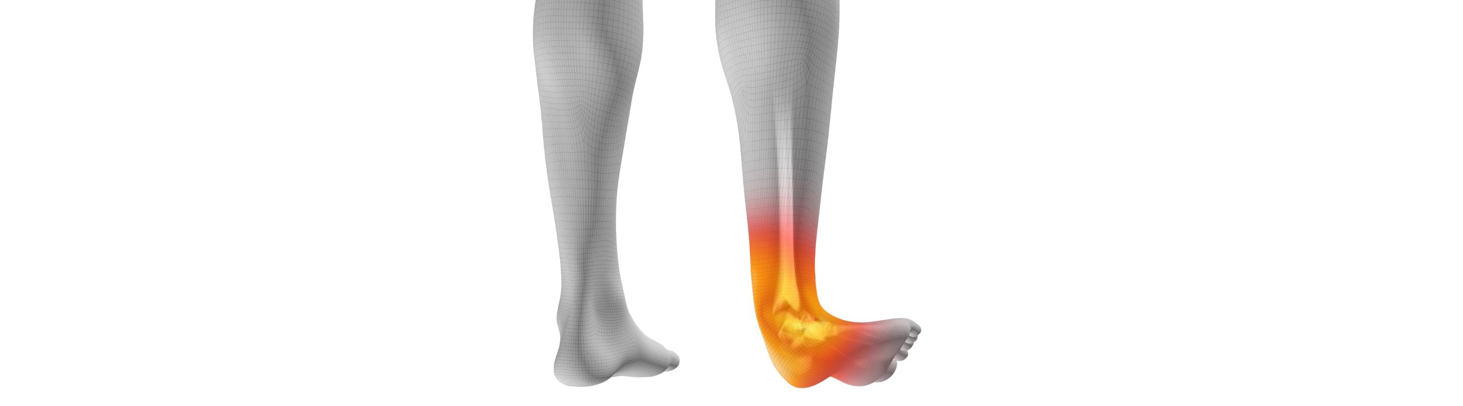grey legs illustration. The right ankle is everted at a sharp angle and highlighted orange, indicating an ankle sprain 