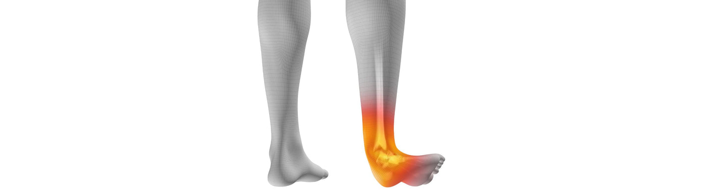 grey legs illustration. The right ankle is everted at a sharp angle and highlighted orange, indicating an ankle sprain 