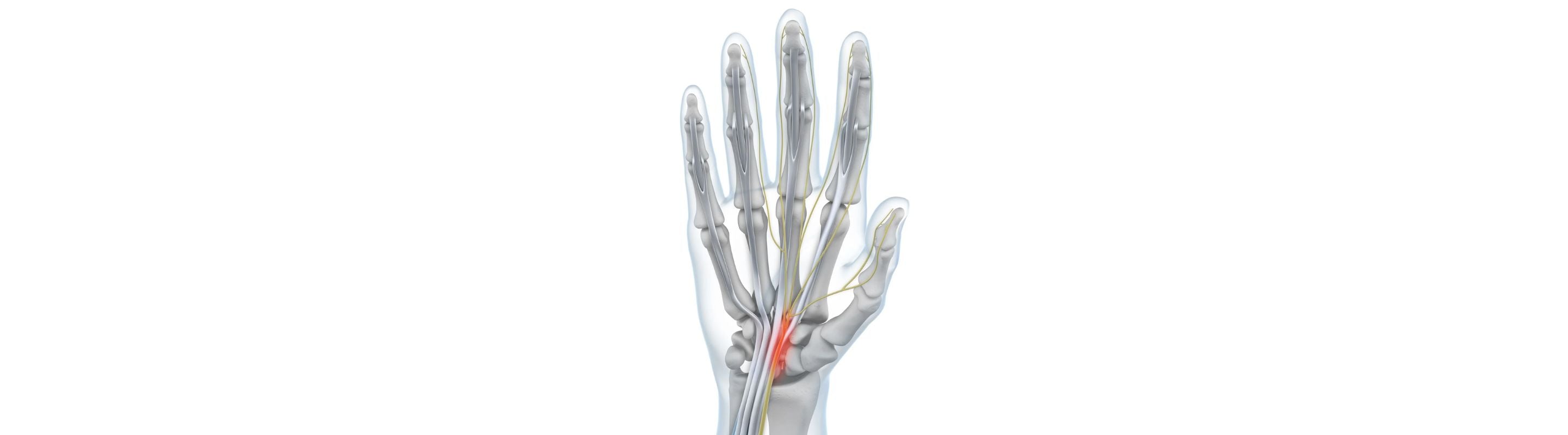 illustration of a hand with see-through skin. The carpal tunnel containing the median nerve is lit up red, indicating carpal tunnel syndrome irritation 