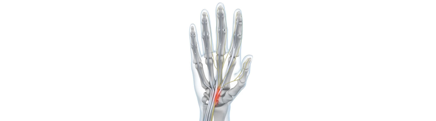 illustration of a hand with see-through skin. The carpal tunnel containing the median nerve is lit up red, indicating carpal tunnel syndrome irritation 