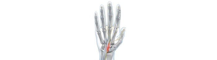 illustration of a hand with see-through skin. The carpal tunnel containing the median nerve is lit up red, indicating carpal tunnel syndrome irritation 