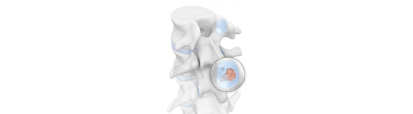 illustration of a handful of spine vertebrae. The image depicts blue cartilage with some orange wear and tear around the facet joints, indicating spondyloarthritis
