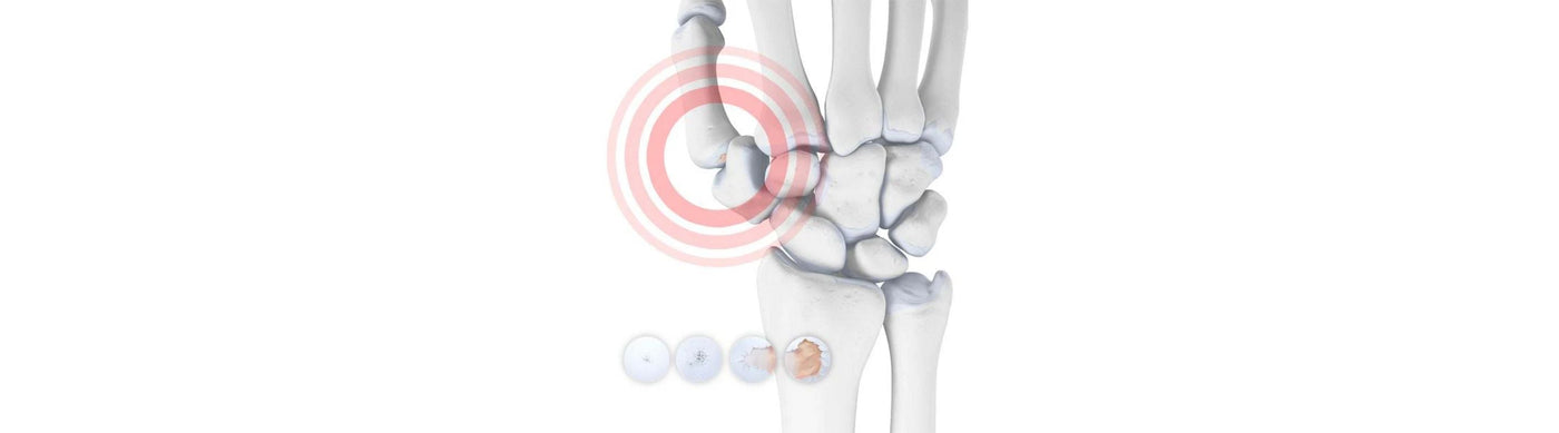illustration of the skeletal wrist and thumb. Over the ilustration are round images depicting cartilage degeneration. Over the bottom of the thumb is an orange circle, indicating a painful area.