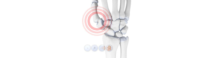 illustration of the skeletal wrist and thumb. Over the ilustration are round images depicting cartilage degeneration. Over the bottom of the thumb is an orange circle, indicating a painful area.