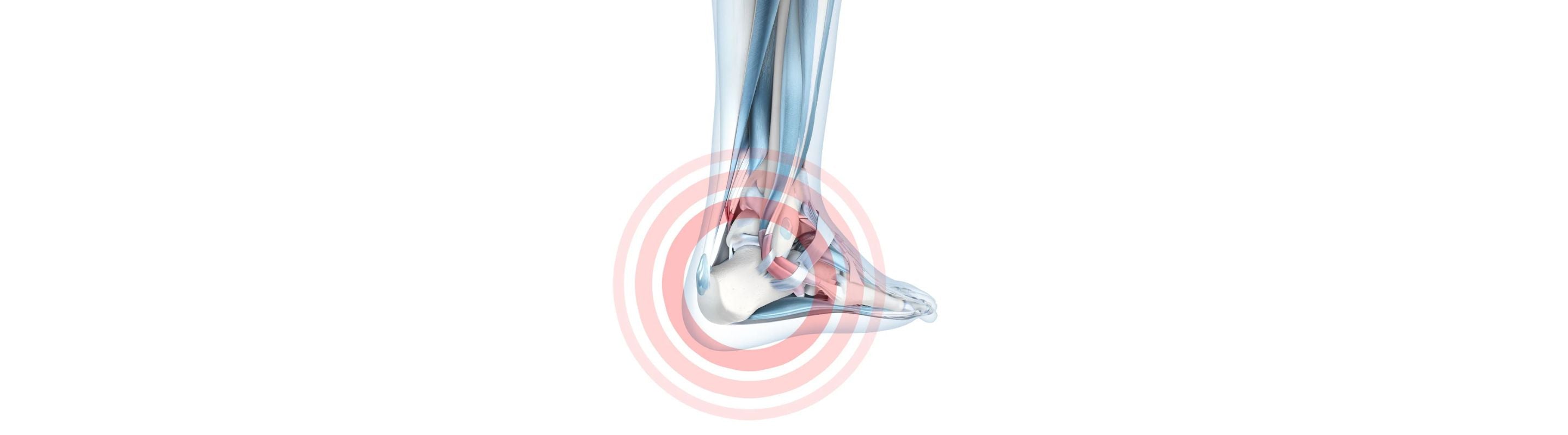 illustration of the foot and ankle. There is a red zone over the heel, indicating pain from work safety boots