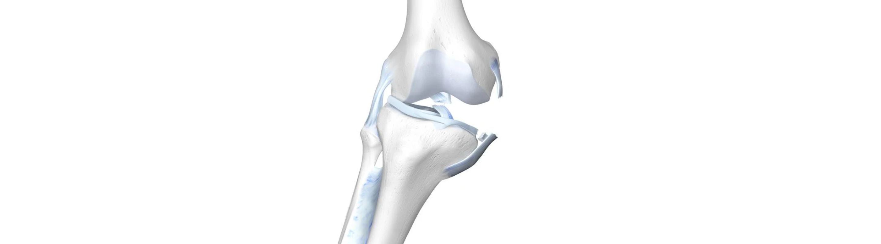 Illustration of the skeletal knee with a damaged ACL, MCL, and meniscus