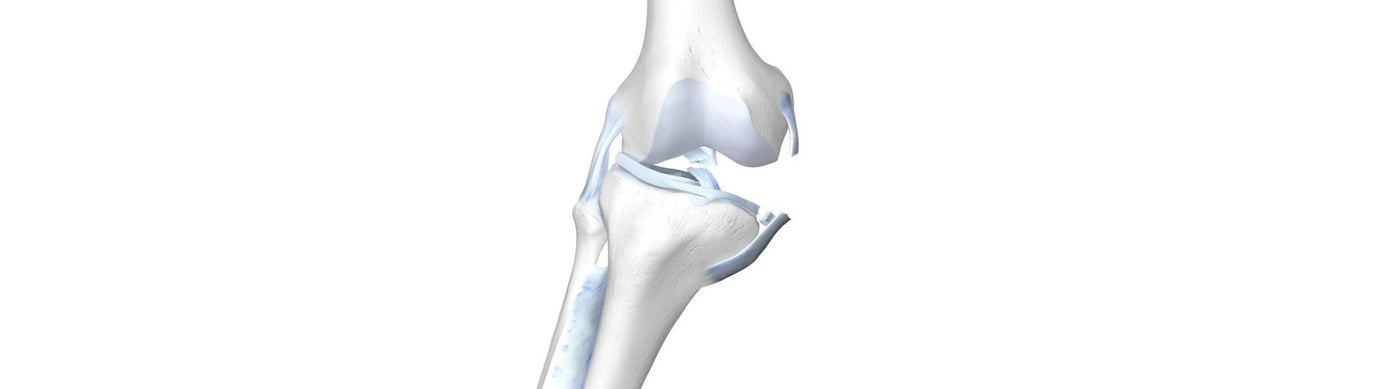 Illustration of the skeletal knee with a damaged ACL, MCL, and meniscus