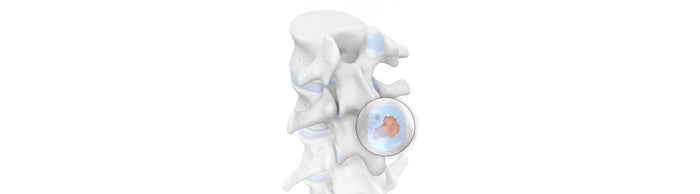 illustration of a handful of spine vertebrae. The image depicts blue cartilage with some orange wear and tear around the facet joints, indicating spondyloarthritis