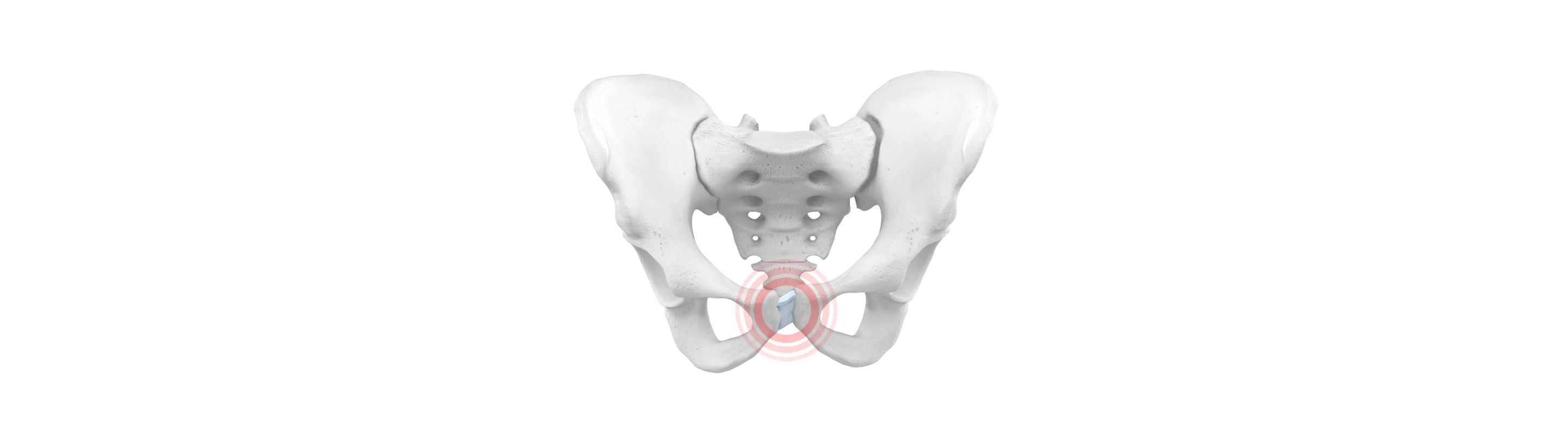Illustration of the pelvic bones. There is a red circle around the pubis bone, indicating symphysis pubis dysfunction 