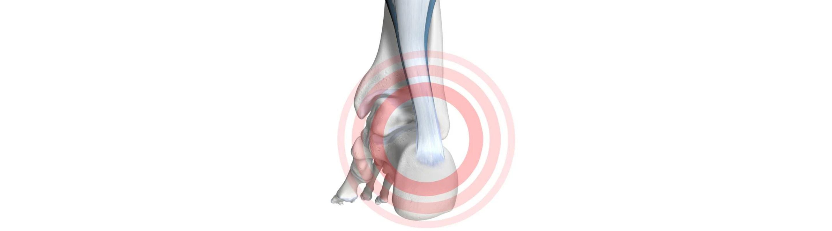 Illustration of the back of the foot and ankle. There is a red circle highlighting Haglund's Deformity in the heel.