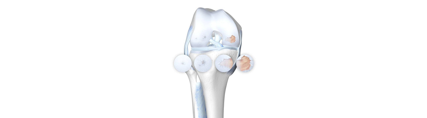 Arthritis in Knee - Diagnosis, Treatment and Prevention