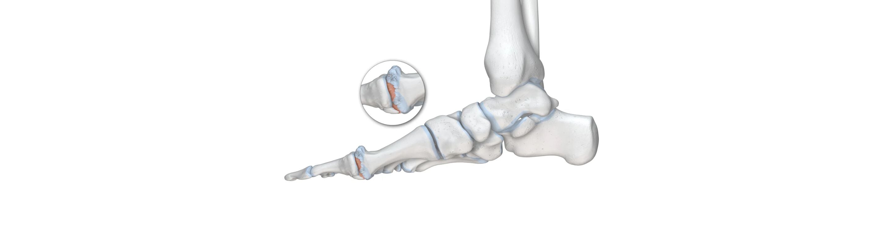 illustration of the skeletal foot. There is a round image overtop zooming in on the thumb joint, which is red with irritation, indicating hallux rigidus