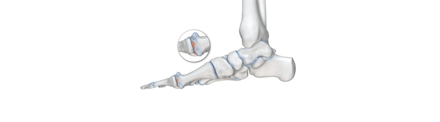 illustration of the skeletal foot. There is a round image overtop zooming in on the thumb joint, which is red with irritation, indicating hallux rigidus