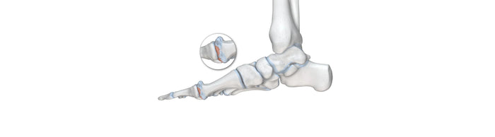 illustration of the skeletal foot. There is a round image overtop zooming in on the thumb joint, which is red with irritation, indicating hallux rigidus