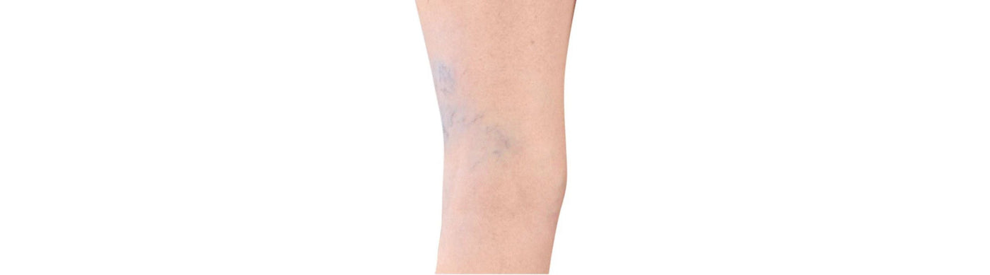 Spider veins on the back of a leg