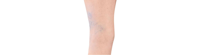 Spider veins on the back of a leg