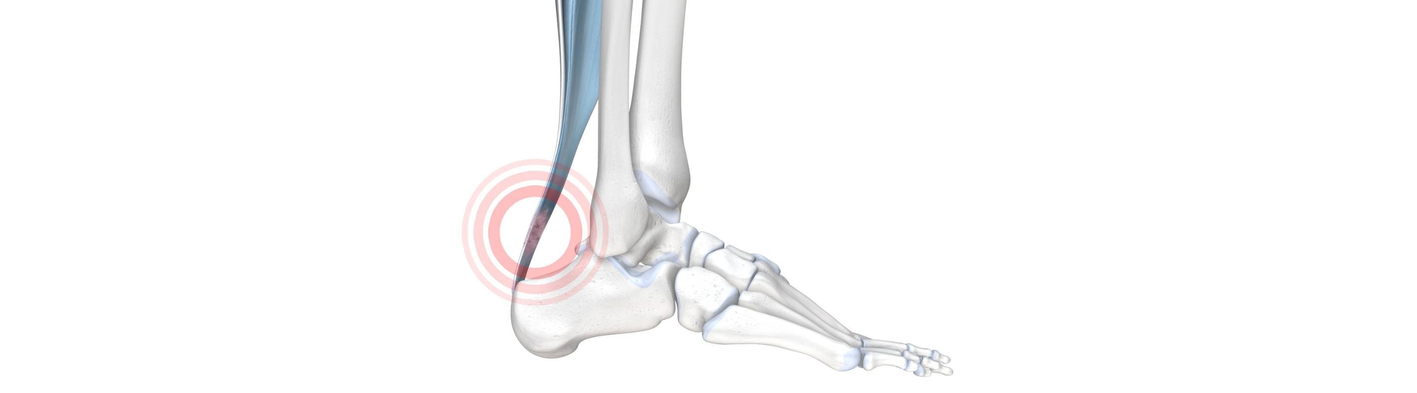 Achillodynia - The Achilles Tendon Pain Syndrome