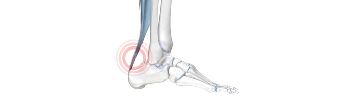 Achillodynia - The Achilles Tendon Pain Syndrome