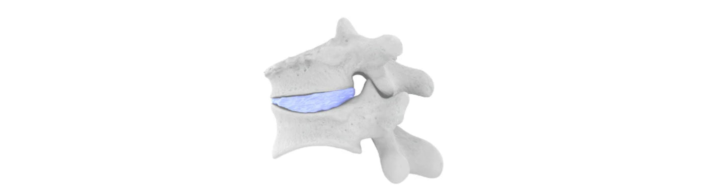image of two vertebrae with a disk in between them. The top vertebra looks to have a crack, indicating a compression fracture.