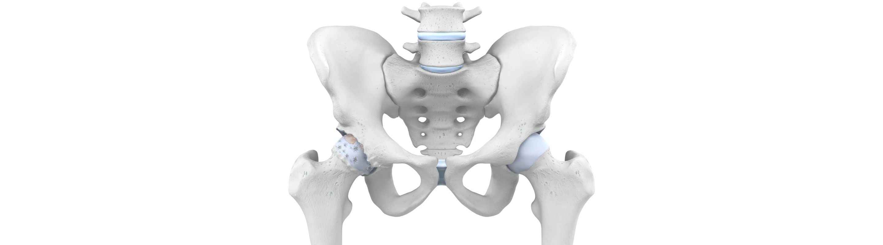 illustration of the skeletal pelvis in grey and light blue. The hip cartilage on the left side is coarser than that on the right, indicating arthritis wear and tear