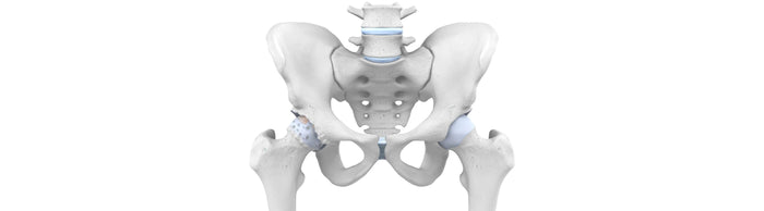 illustration of the skeletal pelvis in grey and light blue. The hip cartilage on the left side is coarser than that on the right, indicating arthritis wear and tear