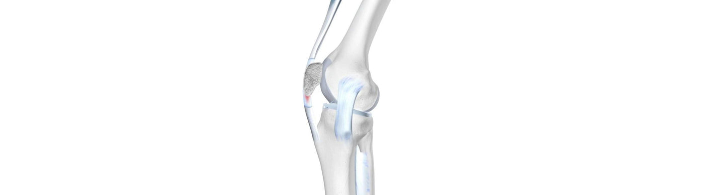 illustration of the skeletal knee. It shows the bony knee joint, the MCL or PCL ligament, and the patellar tendon, which is red to indicate pain.