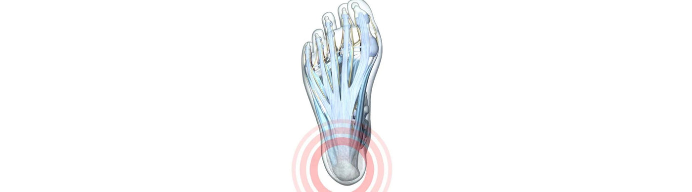 Illustration of the foot with see-through skin. You can see the bones underneath and there is a red circle around the calcaneus, indicating heel pain