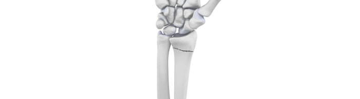 illustration of the arm and wrist bones. The radius has a large crack going horizontally through it, indicating a fracture.