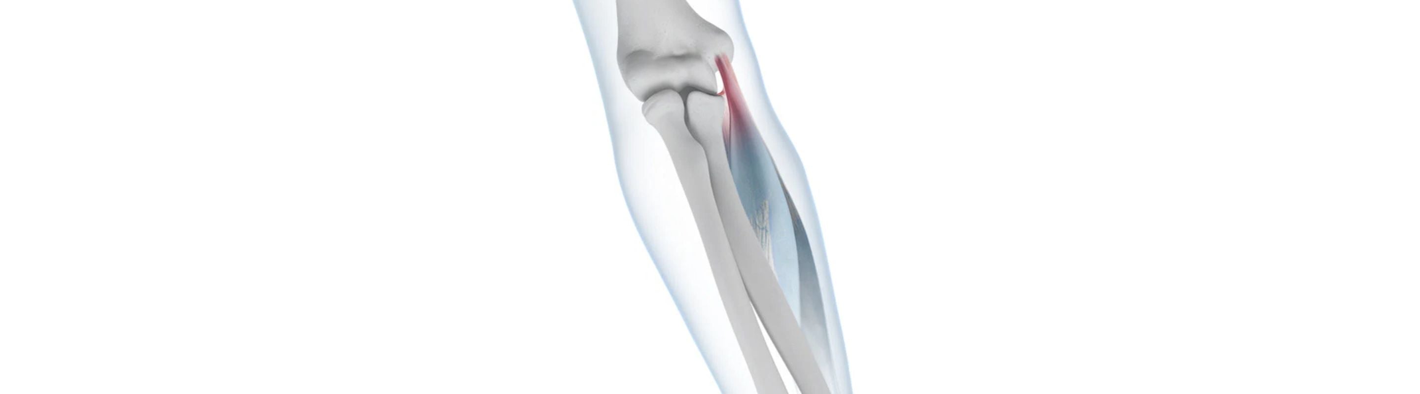 illustration of the arm with se-through skin so you can see the bones and ligaments. One of the epicondyle tendons is red, indicating elbow tendonitis 
