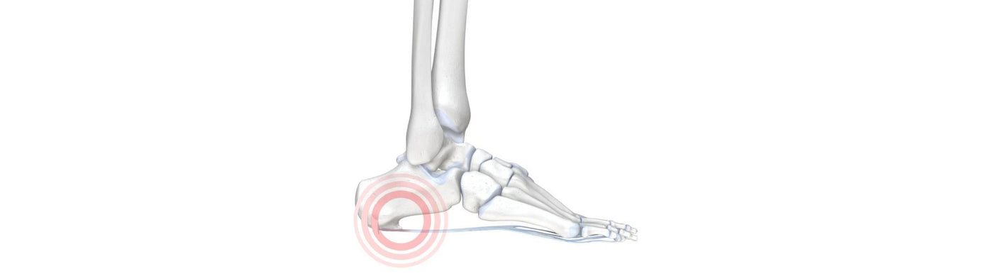 Illustration of a skeletal foot with red circles around the heel, indicating a heel spur.