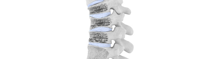 illustration of the spine. 3 of the vertebrae are porous, indicating osteoporosis