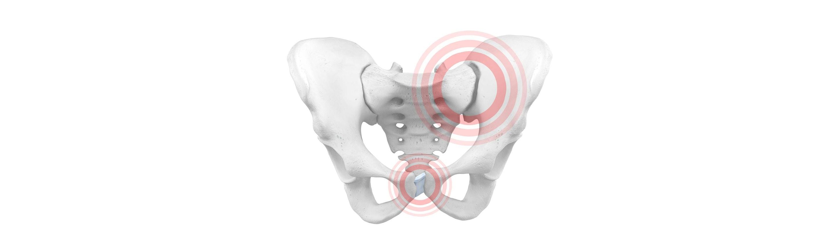 illustration of the pelvic bones. There are two red circles, one over the bottom part of the pelvic and the other near the top right, indicating pelvic girdle instability.