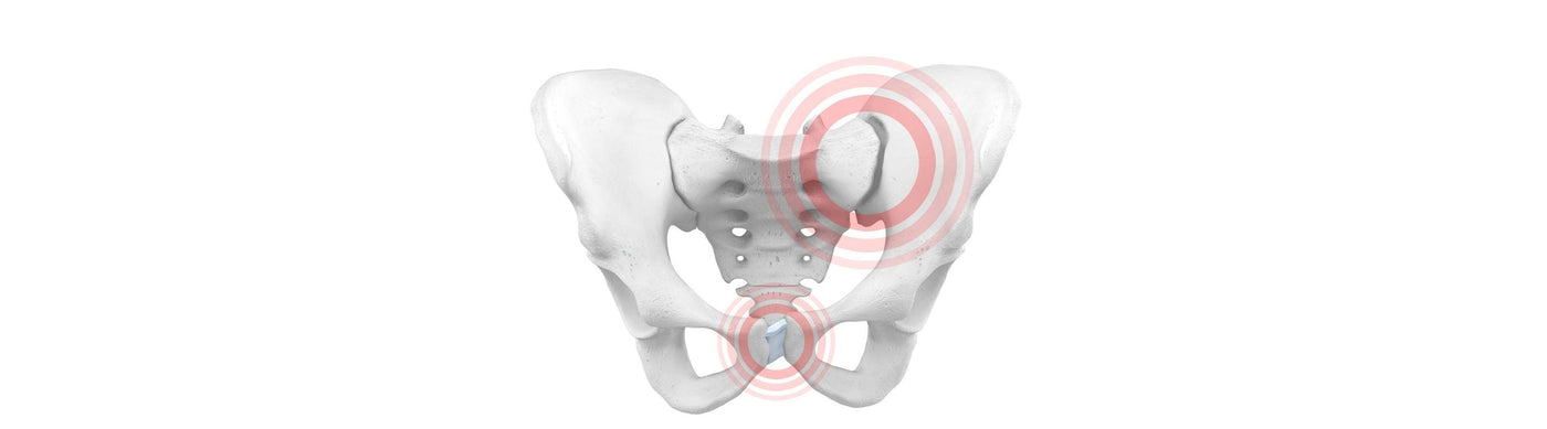 illustration of the pelvic bones. There are two red circles, one over the bottom part of the pelvic and the other near the top right, indicating pelvic girdle instability.