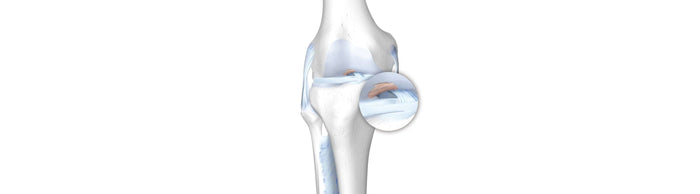 illustration of the skeletal knee. There is redness in the cartilage, indicating osteoarthritis pain and degeneration.