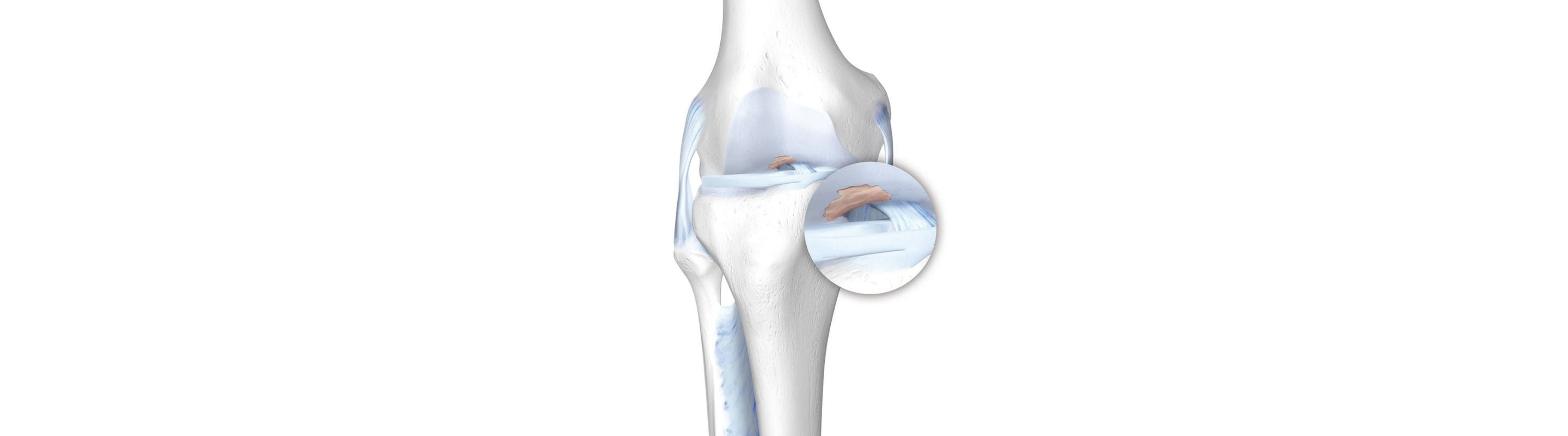 illustration of the skeletal knee. There is redness in the cartilage, indicating osteoarthritis pain and degeneration.