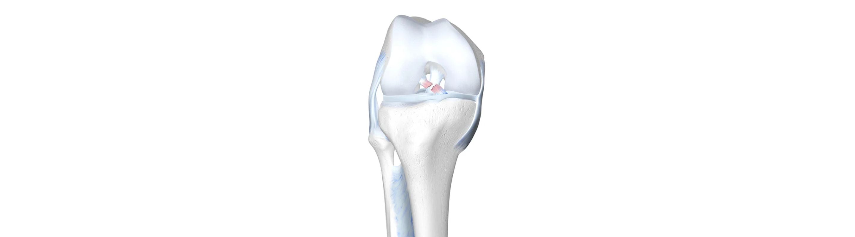 Illustration of a skeletal knee. The cruciate ligament at the centre of the knee is red and ruptured