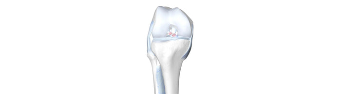 Illustration of a skeletal knee. The cruciate ligament at the centre of the knee is red and ruptured