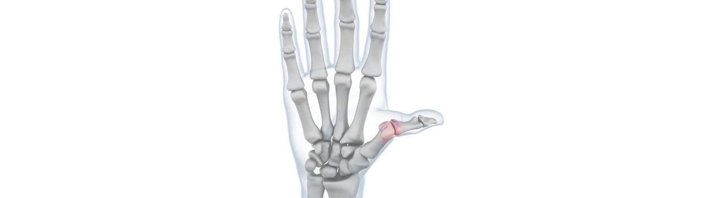 illustration of a hand with see-throgh skin. There is a red zone over the thumb joint, indicating skier's thumb irritation