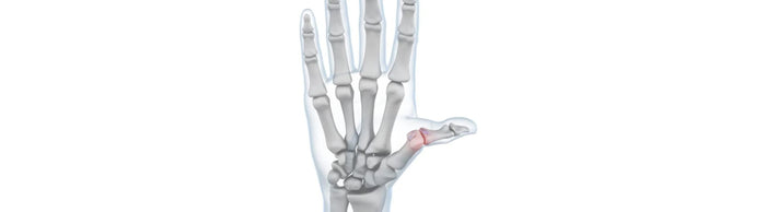 illustration of a hand with see-throgh skin. There is a red zone over the thumb joint, indicating skier's thumb irritation
