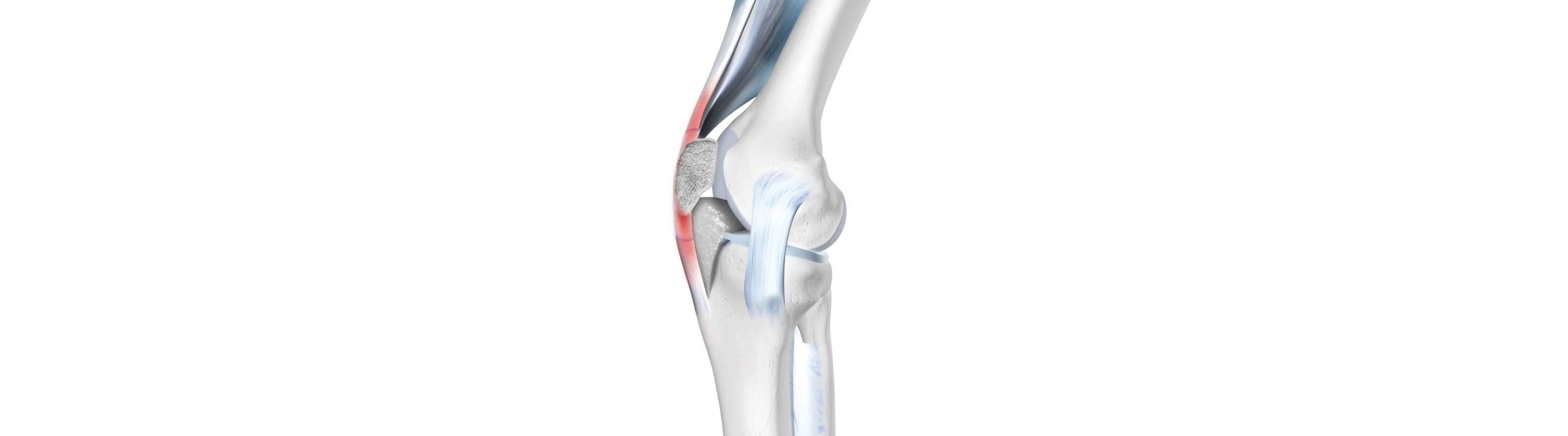 Illustration of the skeletal knee There is red throughout the patellar tendon, indicating pain from tendonitis