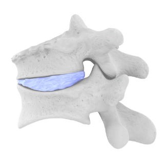 Vertebral Compression Fractures